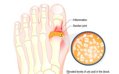 Uutta tietoa kihdistä ja ravintovalinnoista