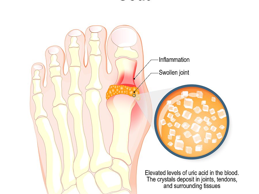 Uutta tietoa kihdistä ja ravintovalinnoista