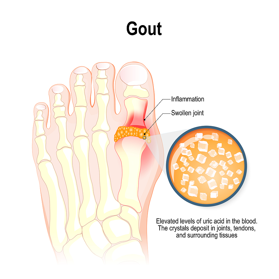 Gout Is A Form Of Inflammatory Arthritis. Characterized By Eleva
